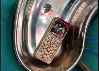 ରାଗରେ ଉଭଣୀ ଗିଳିଦେଲା ମୋବାଇଲ , ୨ ଘଣ୍ଟାର ଅପରେସନ ପରେ ଜୀବନ ବଞ୍ଚାଇଲେ ଡାକ୍ତର