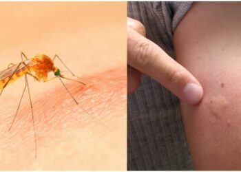 ମଶା କାମୁଡାରେ ଚର୍ମ ଲାଲ୍ ପଡିଯାଉଛି କି ? ଆପଣାନ୍ତୁ ଏହି ଘରୋଇ ଉପାୟ