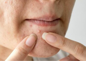 ଗୋଟିଏ ରାତିରେ ବ୍ରଣରୁ ମୁକ୍ତି ପାଆନ୍ତୁ, ଆପଣାନ୍ତୁ ଏହି ସବୁ ଉପାୟ