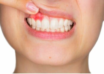 ଆପଣଙ୍କ ଦାନ୍ତ ମାଢିରେ ରକ୍ତ ଦେଖି ଆପଣ ଚିନ୍ତିତ କି? ଏହି କୈାଶଳ ମାଧ୍ୟମରେ ରକ୍ତସ୍ରାବ ହେବ ଦୂର