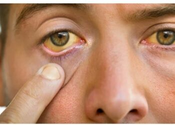 ବର୍ଷା ଦିନରେ ଆପଣଙ୍କୁ ବି ହୋଇପାରେ ଜଣ୍ଡିସ ରୋଗ , ଜାଣନ୍ତୁ ଏହି ରୋଗ ହେଲେ କେଉଁ ସବୁ ଖାଦ୍ୟରୁ ଦୂରେଇ ରହିବା