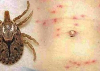 ୨୪ ଘଣ୍ଟାରେ ଆଉ ୭ ଜଣ ସ୍କ୍ରବ୍ ଟାଇଫସ ଆକ୍ରାନ୍ତ ଚିହ୍ନଟ