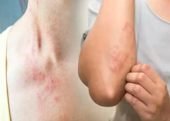 ସୁନ୍ଦରଗଡରେ ଆଉ ୩ ସ୍କ୍ରବ୍ ଟାଇଫସ