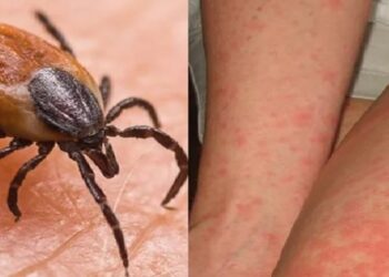 ସୁନ୍ଦରଗଡରେ ଆଉ ୧୪ ସ୍କ୍ରବ ଟାଇଫସ