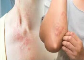 ସ୍କ୍ରବ ଟାଇଫସ : ଦିନକରେ ୧୪ ପଜିଟିଭ ଚିହ୍ନଟ