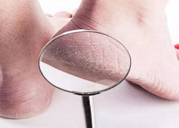 ଶୀତଦିନେ ଆପଣଙ୍କର ଫାଟୁଛି କି , ଆପଣାନ୍ତୁ ଏହି ଉପାୟ..