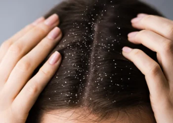 ରୂପି ସମସ୍ୟାକୁ ନେଇ ଚିନ୍ତିତ ରହୁଛନ୍ତି କି ? ଘରେ କରନ୍ତୁ ଏହି ସବୁ ଉପାୟ…..