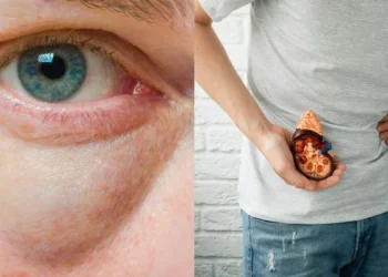 ଆଖି ଫୁଲିବା ହୋଇପାରେ କିଡନୀ ସମସ୍ୟା !